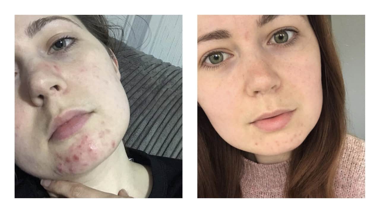 Acne Prone Skincare Routine Before and After